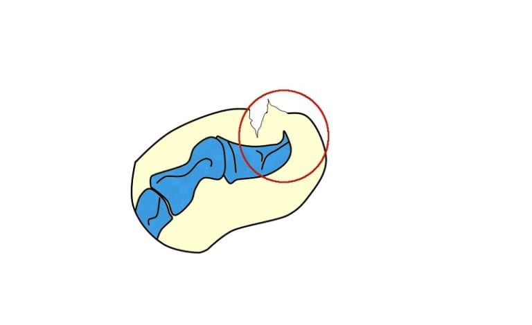 Osteocondroma-subungueal - subungual osteochondroma