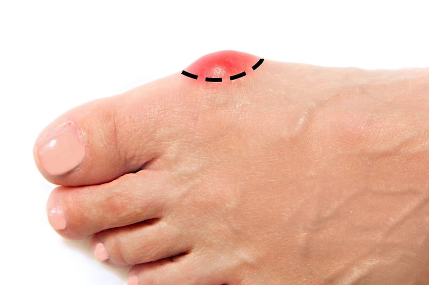 how is the surgery to correct bunions?