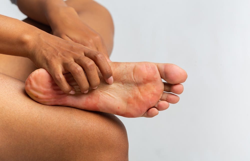 Chirurgie pour traiter la métatarsalgie : finies les douleurs dans les coussinets du pied.