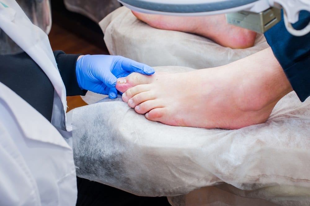 Podologische Chirurgie mit minimaler Inzision, schnelle und nicht-traumatische Korrektur von Fußproblemen