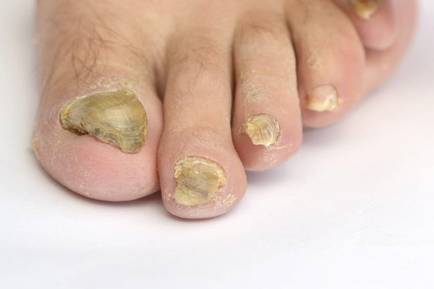 infección por hongos en los pies 