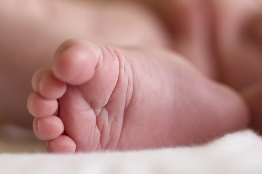 Häufigste Fuß Fehlbildungen bei neugeborenen oder Kindern