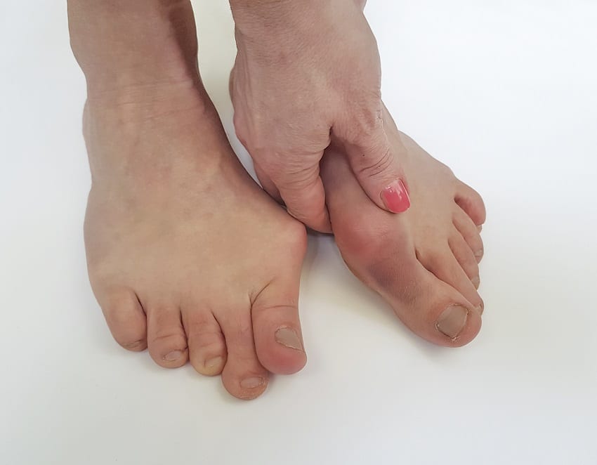 what to do if you have bunions