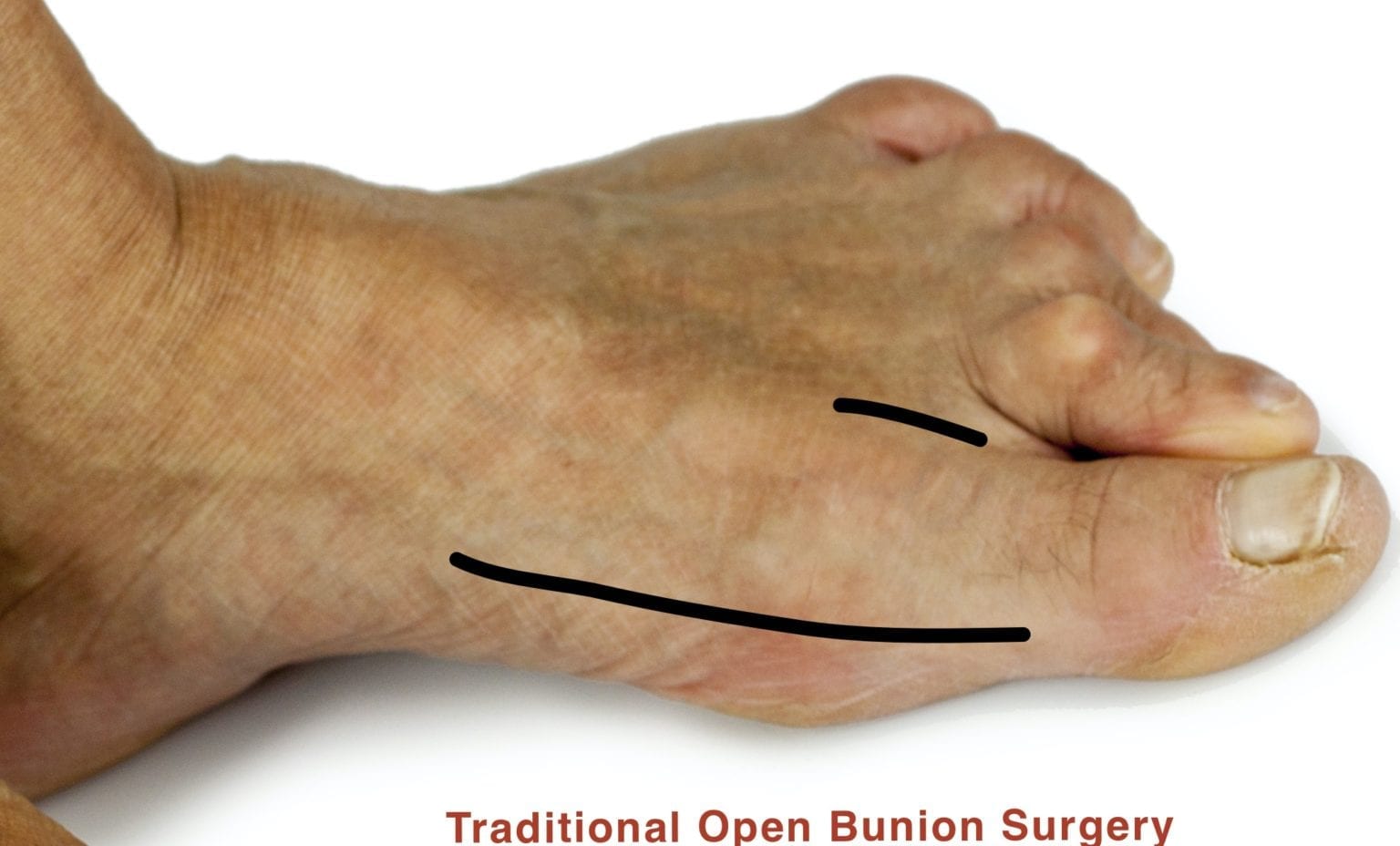 Minimally Invasive Operation Percutaneous Hallux Valgus Bunion