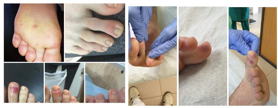 skin and foot manifestations of Covid-19
