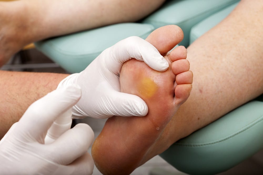 pieds brûlés examinés par un podologue