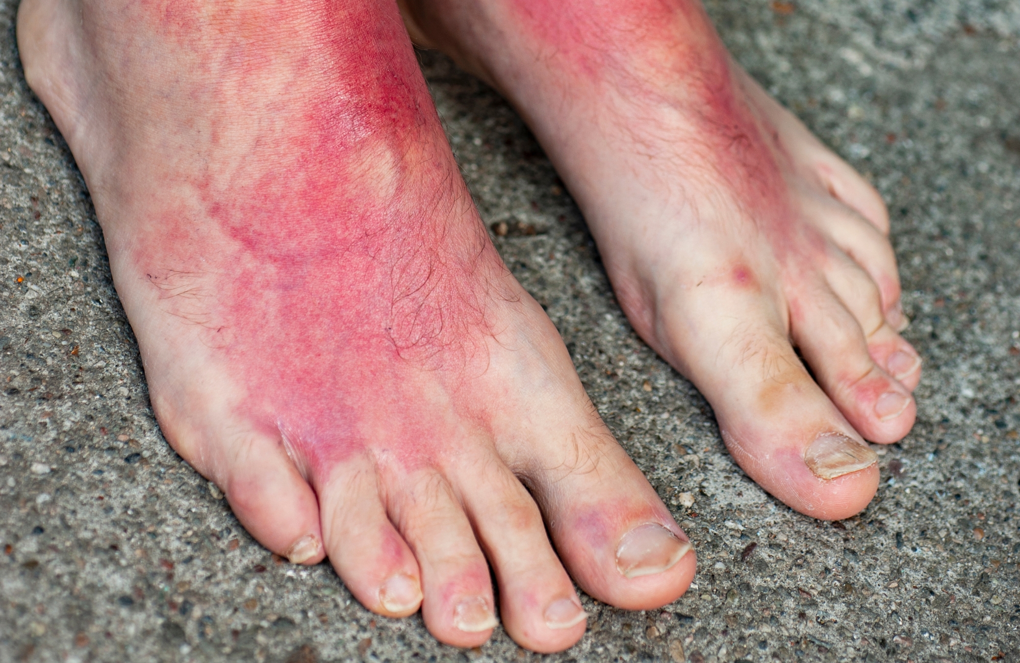 recognizing a sunburn on the feet