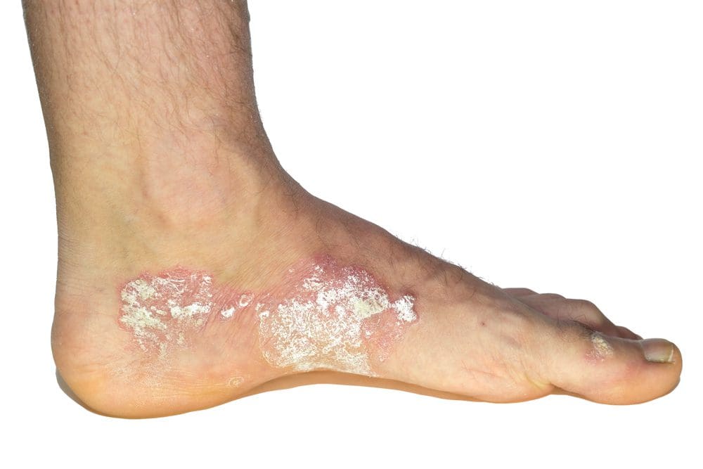 Psoriasis en el pie aislada sobre fondo blanco 1