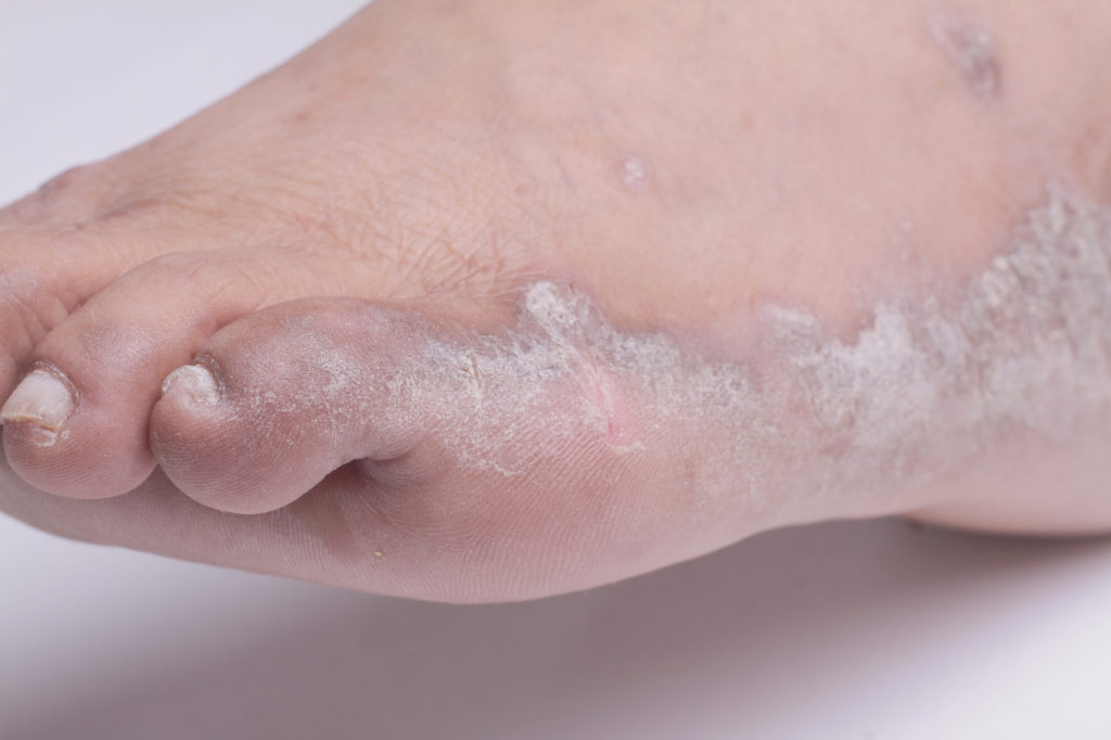 Psoriasis en los Pies