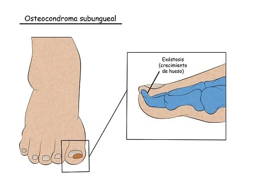 subungual osteochondroma
