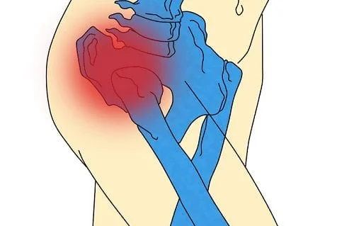 artrosis de cadera 1