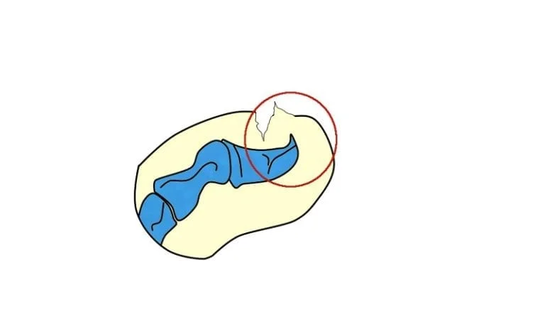 Osteocondroma subungueal ilustracion