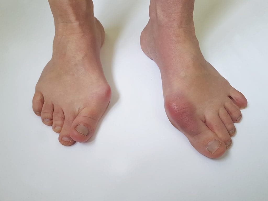 pies con deformidad juanetes - cuando operarse de juanetes - cuando operarse de juanetes