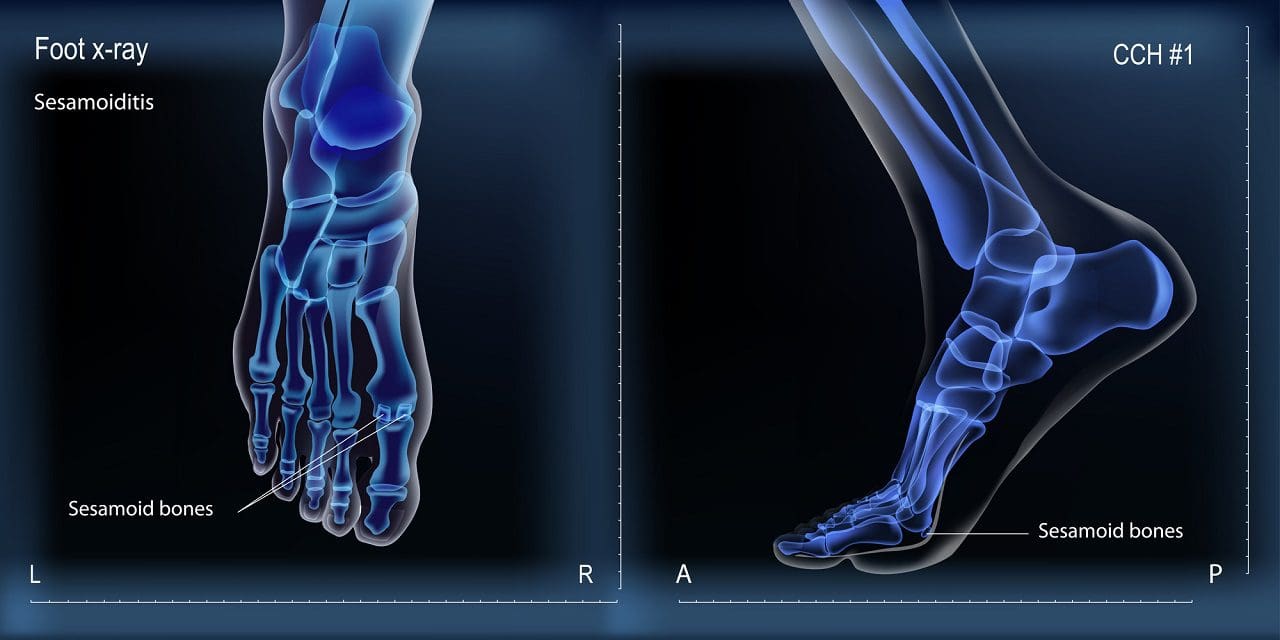 Vue médiane et supérieure des radiographies des os du pied atteints de sésamoïdite