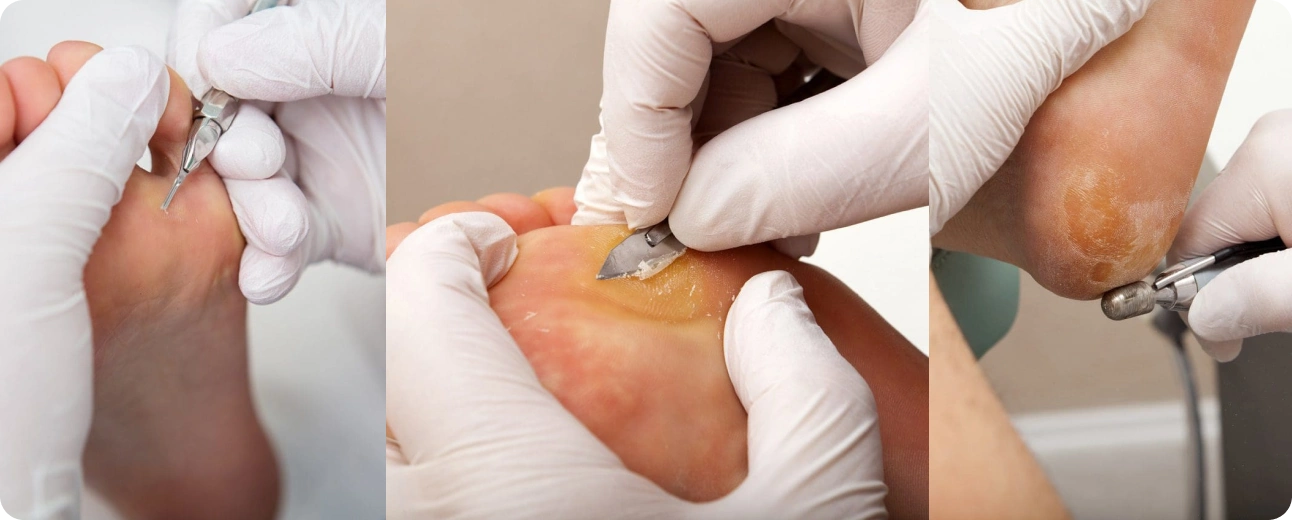 Tratamientos podológicos para durezas, callosidades y helomas en distintas zonas del pie — Clínica San Román Alicante