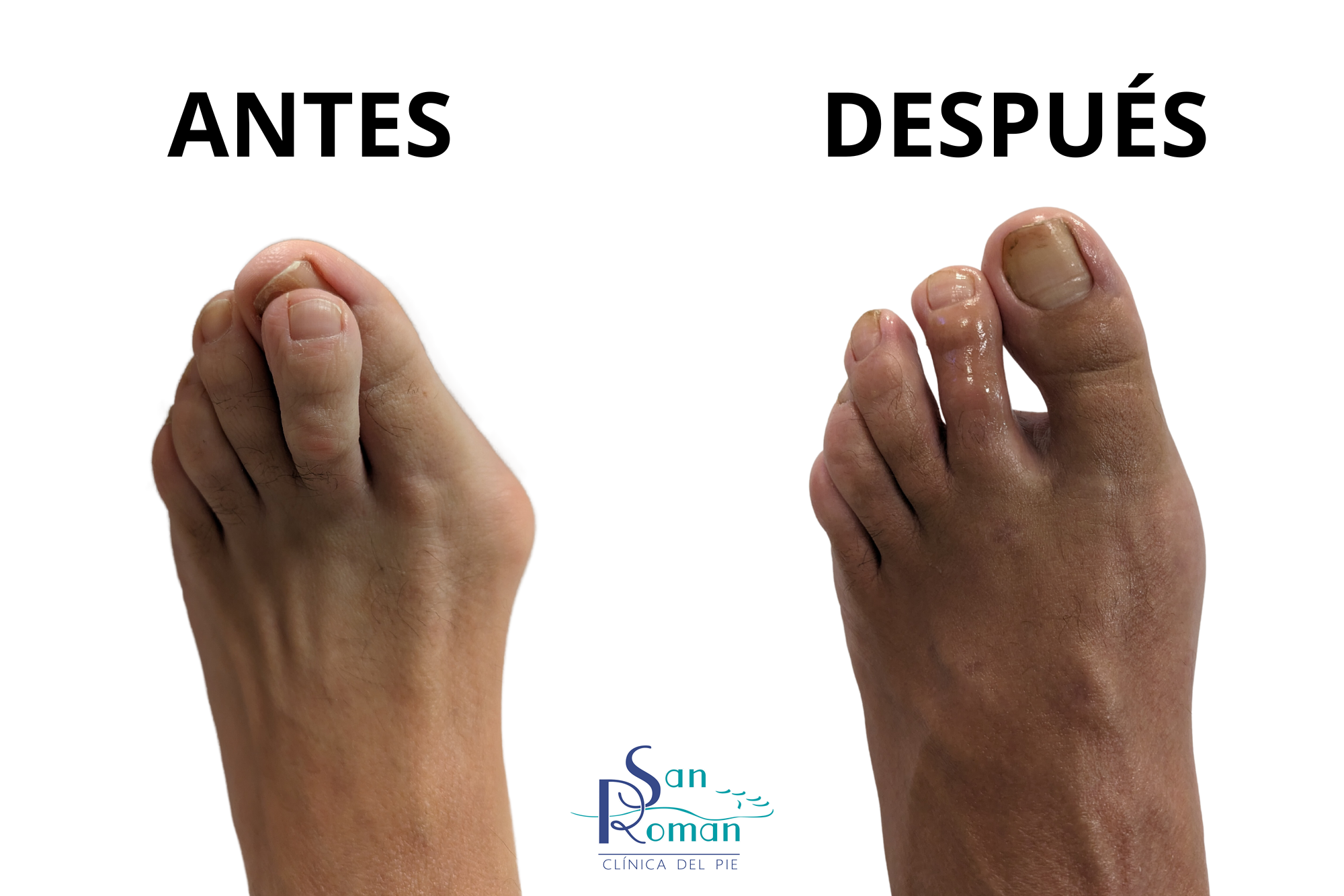 deformidades del pie antes y después de la cirugía mínima invasiva