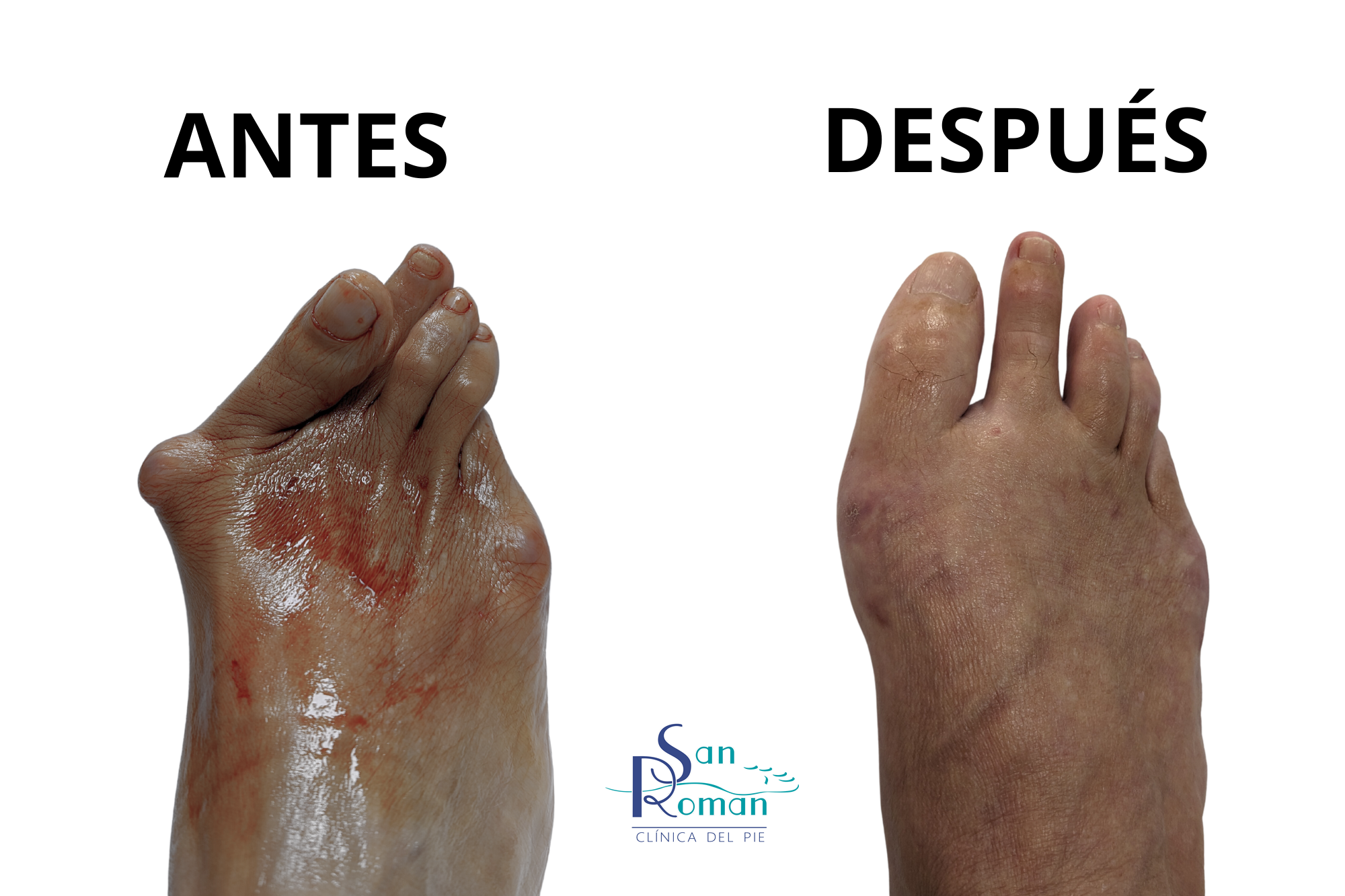 deformidades del pie antes y después de la cirugía mínima invasiva