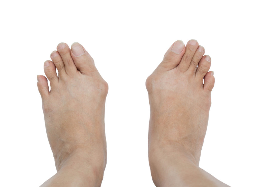 hallux valgus nuevo