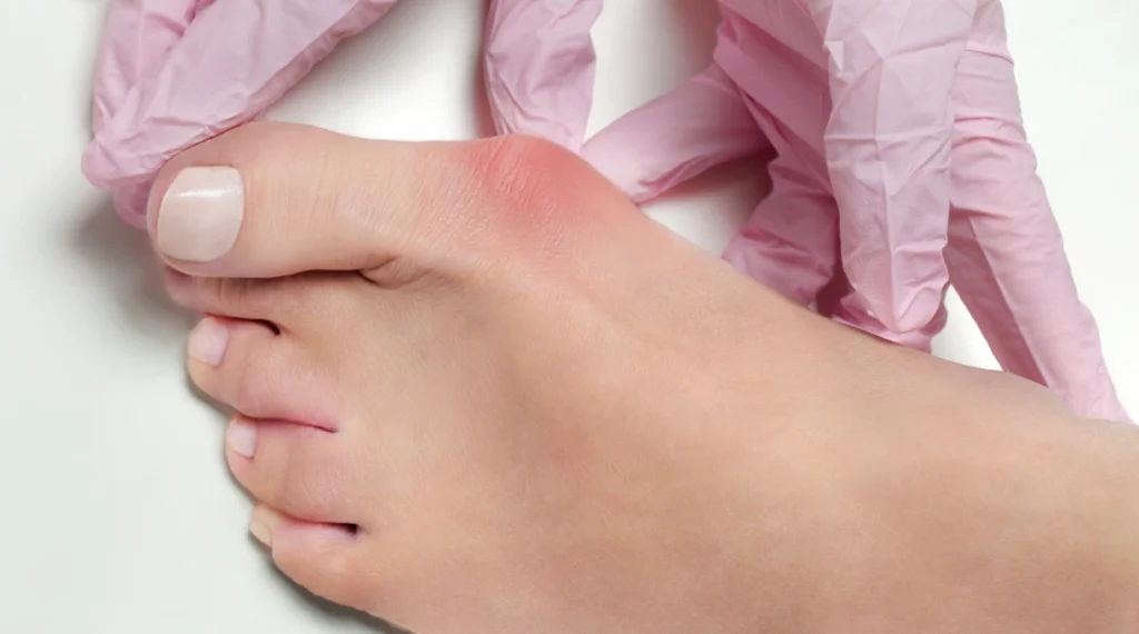 The advantages of minimally invasive surgery to treat bunions