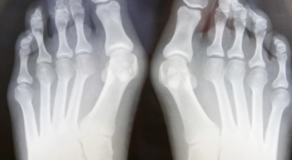 Radiografía de pies con juanetes hallux valgus