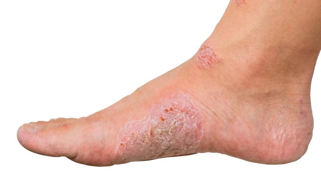 Ekzem und Psoriasis-1 Ekzem und Psoriasis-1