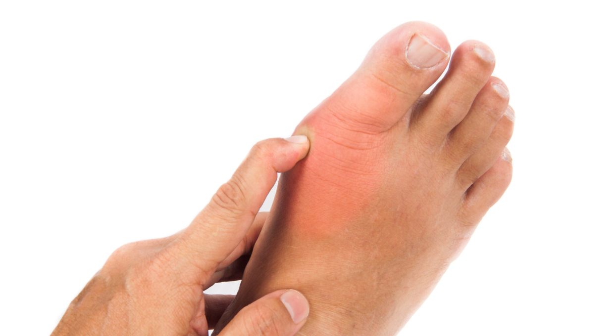 hallux valgus bunions