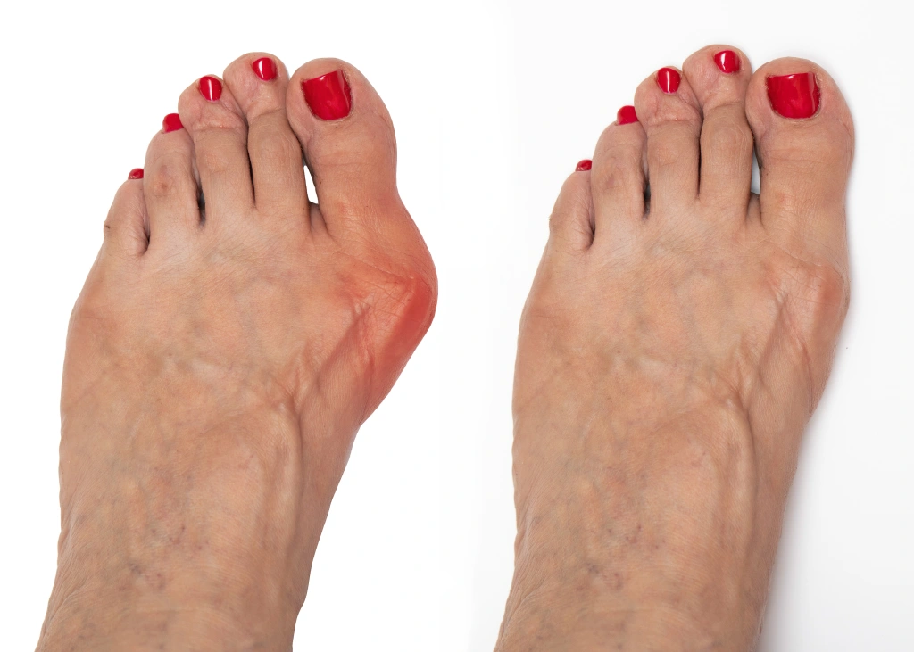 voor en na bunionchirurgie voor en na bunionchirurgie