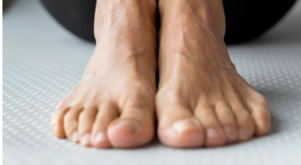 bunionette operatie herstel-1 bunionette operatie herstel-1