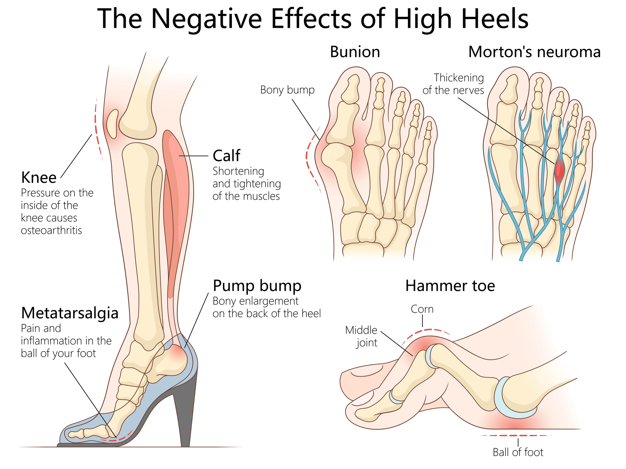 Calzado de tacón alto como causa frecuente de deformidades del pie