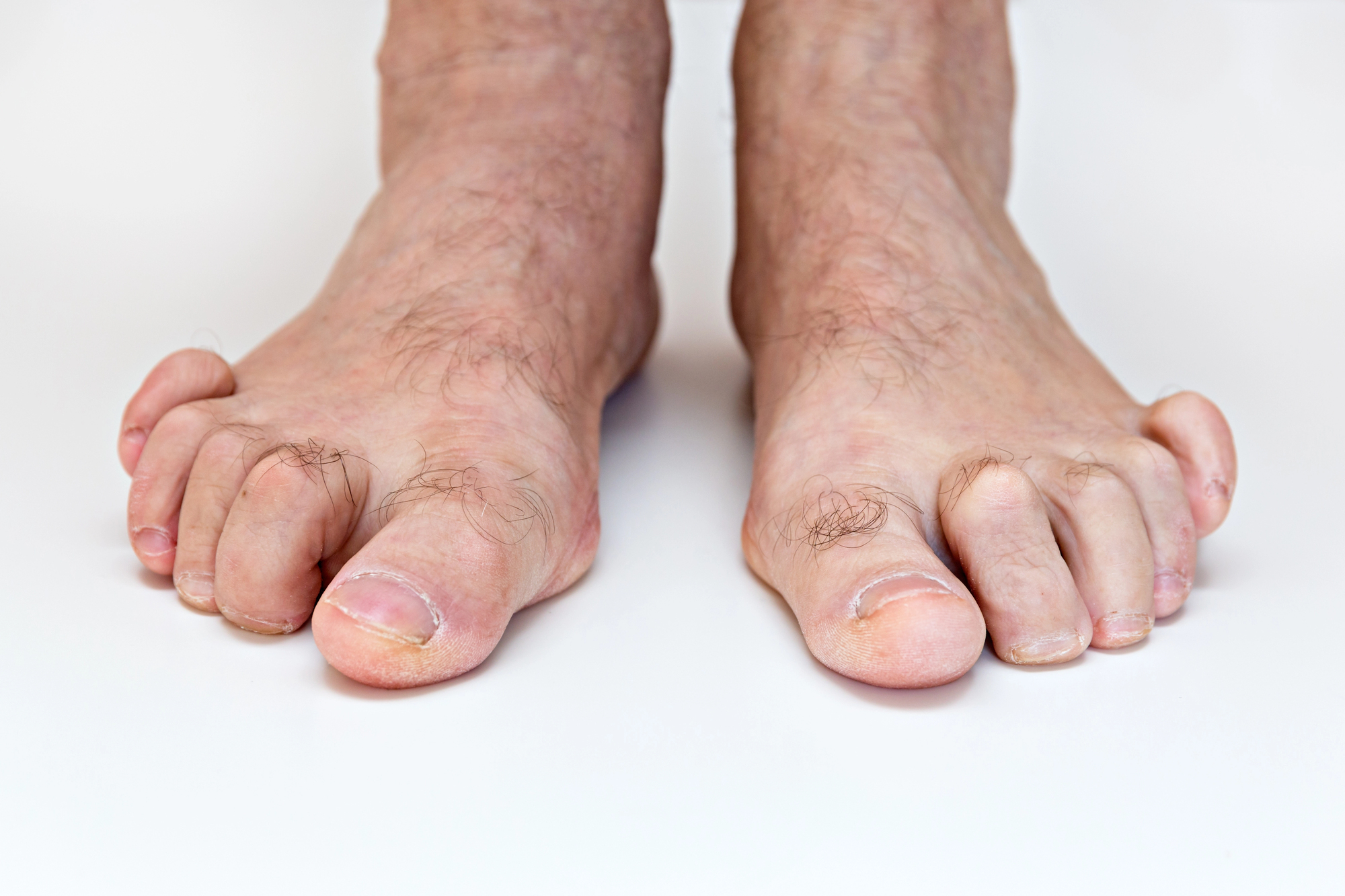 Pies con dedos en martillo y dedos en garra — Clínica San Román Alicante especialistas en cirugía MIS