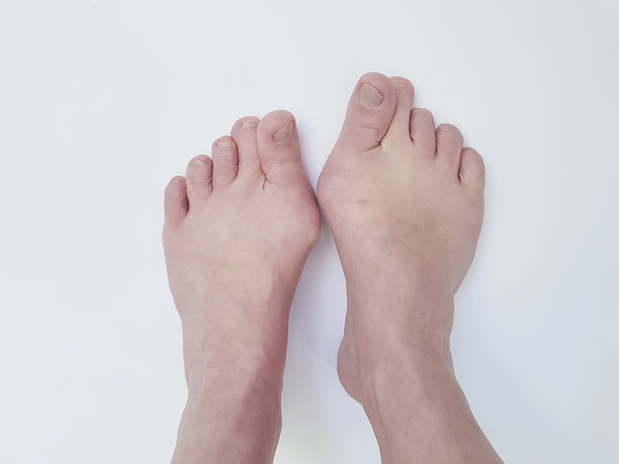 Pie con hallux valgus o juanete — Clínica San Román Alicante especialistas en cirugía MIS