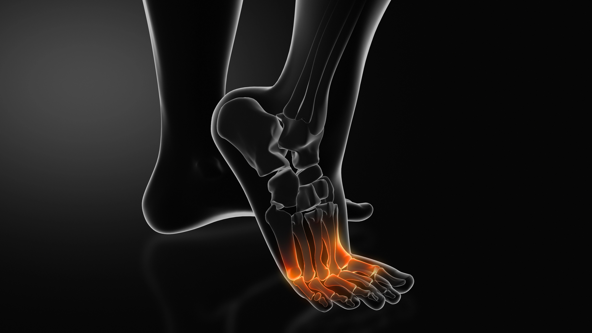 Metatarsalgia — dolor en la planta del antepié por sobrecarga metatarsal