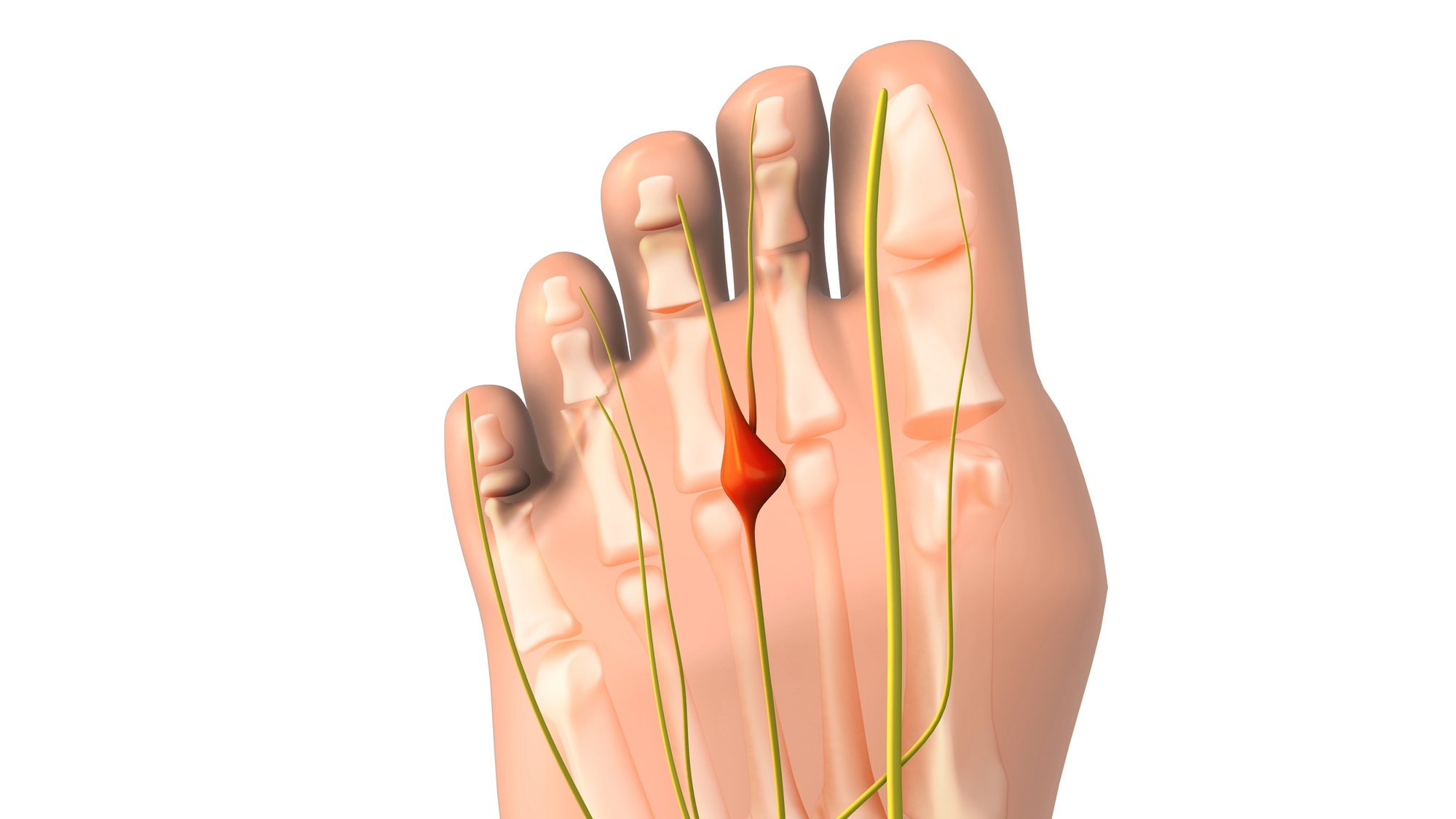Anatomía del neuroma de Morton — nervio interdigital comprimido