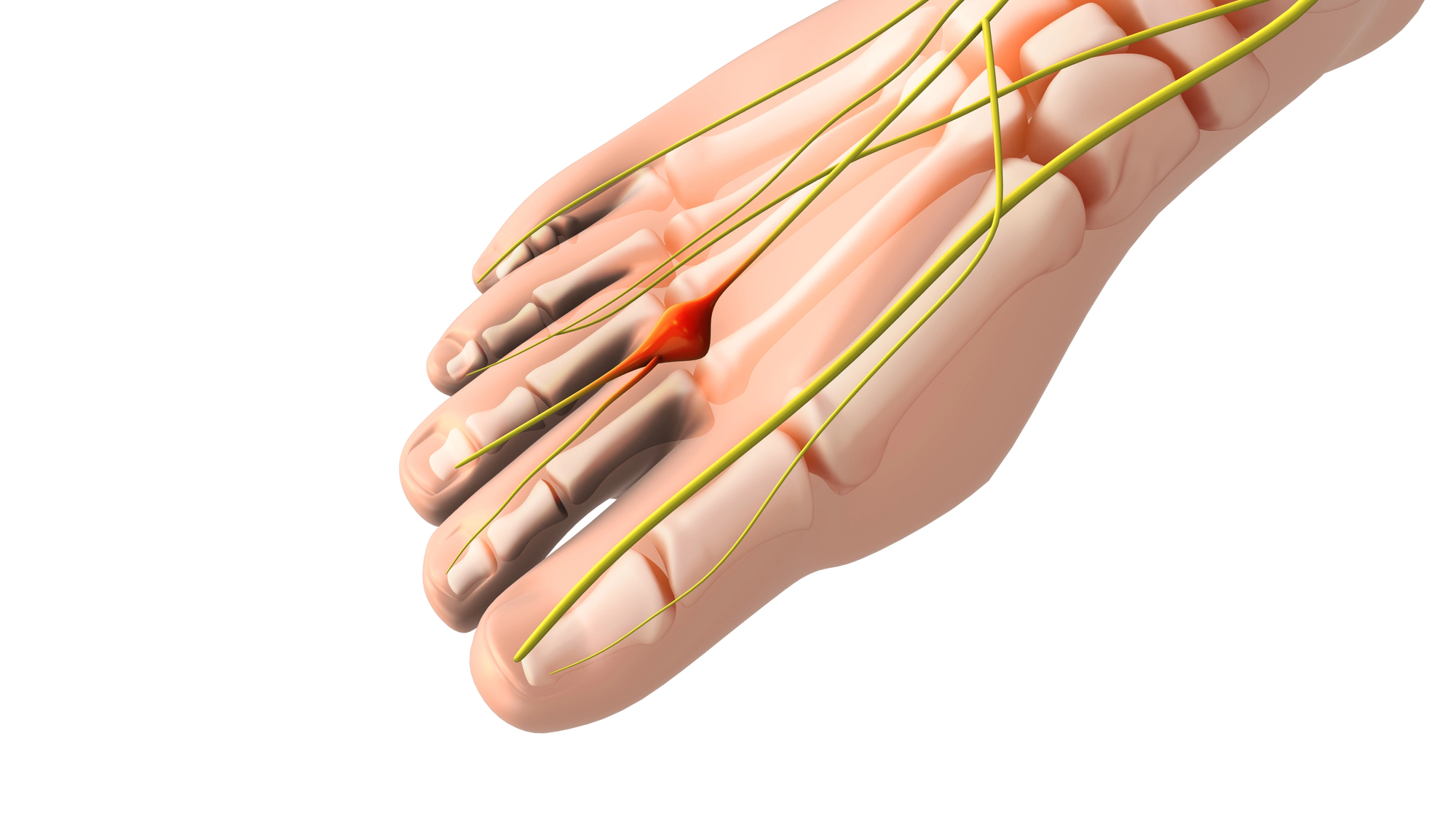 Tratamiento del neuroma de Morton — Clínica San Román Alicante