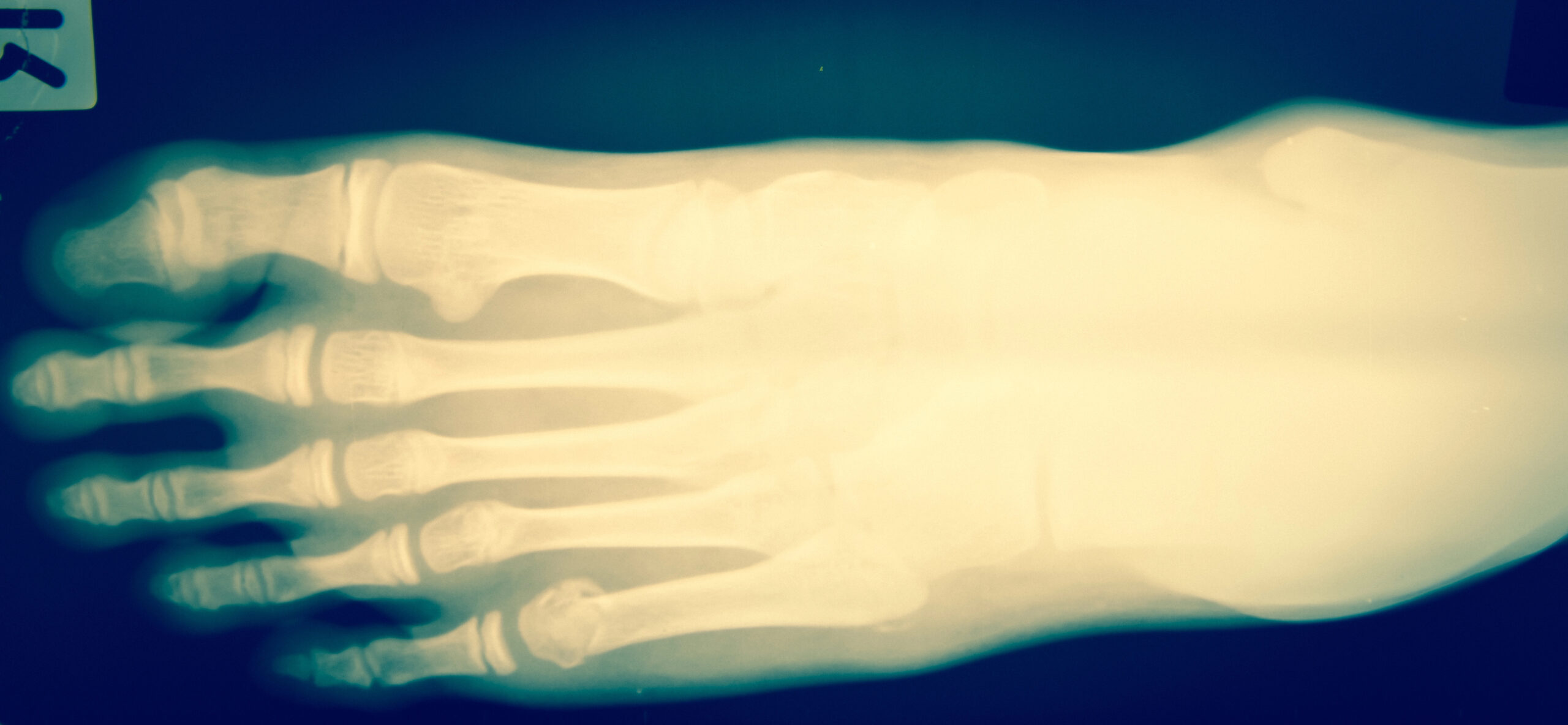 Anatomía del osteocondroma subungueal bajo la matriz ungueal — Clínica San Román Alicante