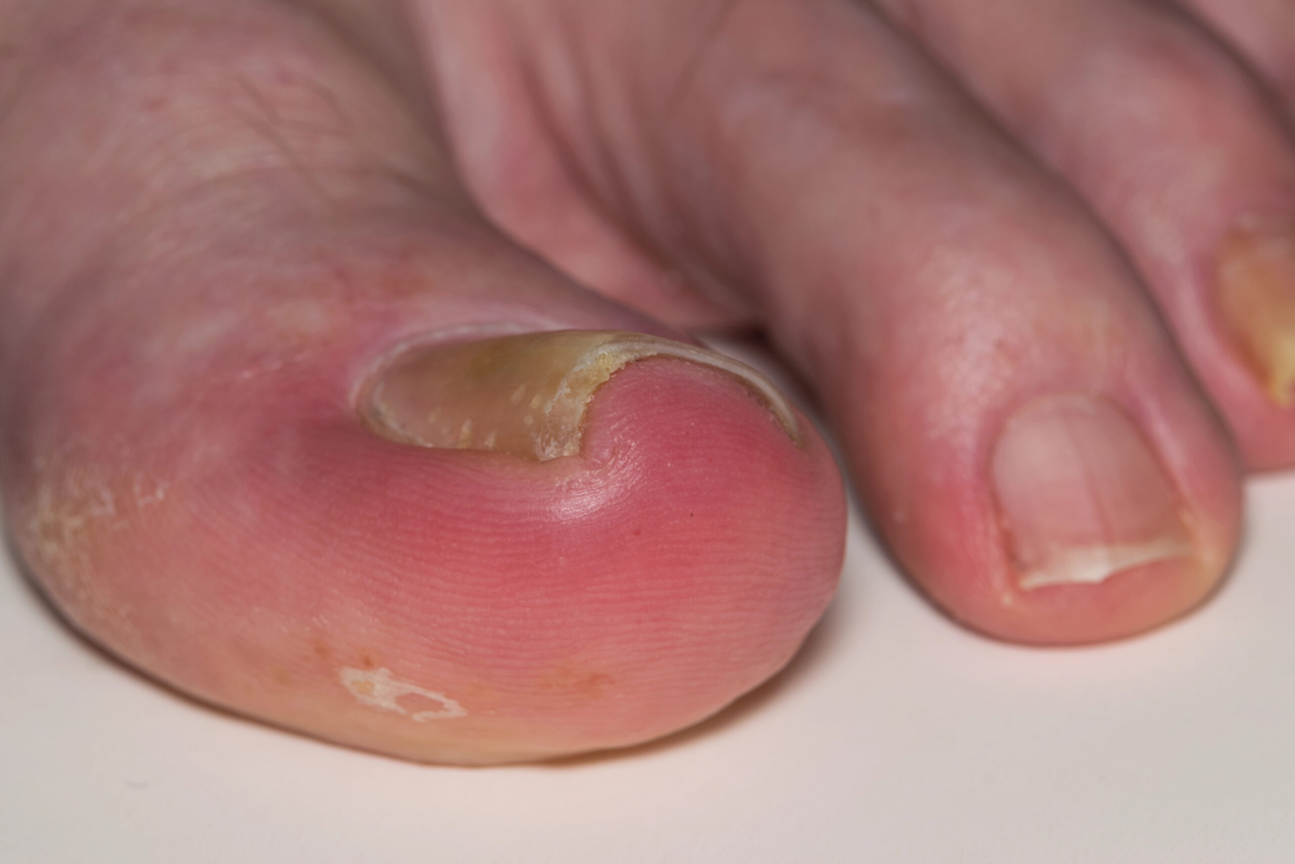 Tratamiento del osteocondroma subungueal con cirugía MIS — Clínica San Román Alicante