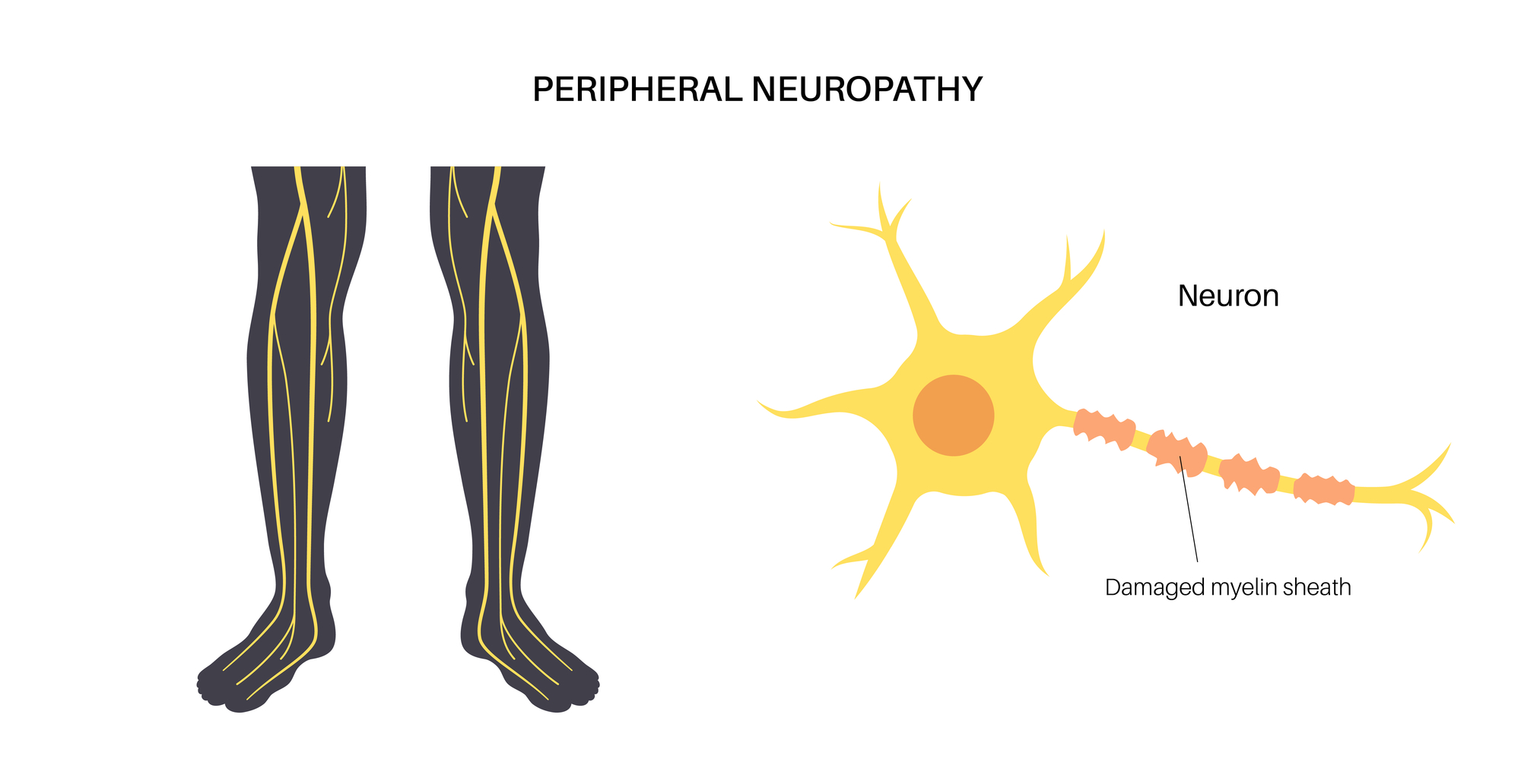 Anatomie van de diabetische voet met neuropathie en perifere arteriopathie - Clínica San Román Alicante