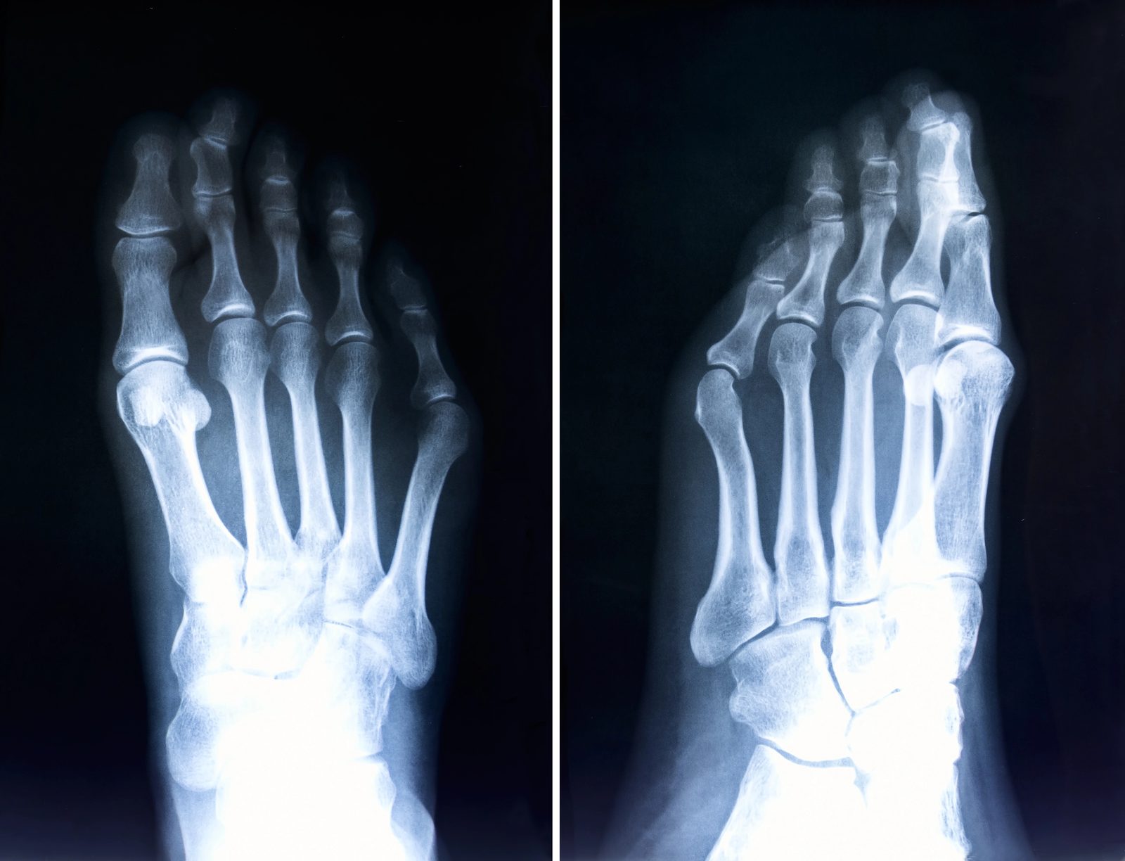 Belastete Röntgenaufnahme beider Füße mit Hallux valgus zur Messung des Abweichungsgrades